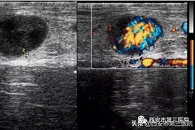 【超声科普】发现颈部淋巴结肿大怎么办？图片