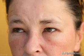 眼睛出现这6个症状，说明你有可能得了甲状腺眼病图片