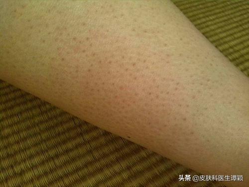 男朋友鸡皮肤太严重