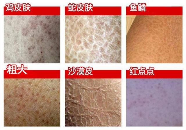 鸡皮肤是显性遗传吗