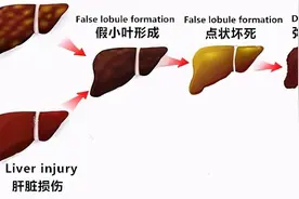 超声检查中，肝脏B超报告单常见术语全在这里，都有必要了解图片