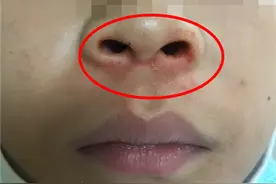 10岁学生连续“鼻出血”，血还无法清洗？医生却说：需要家庭治疗图片