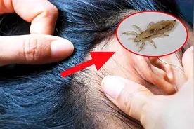 ​几十年前农村很多人头上都有虱子，为何如今突然没了？图片