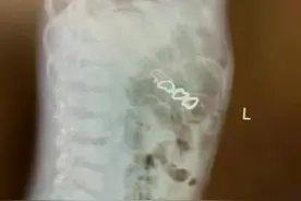 1岁女孩扯下妈妈的耳环，还吞了进去，差点肠穿孔图片