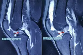 重建前交叉韧带，大学生“灌篮高手”重返篮球场图片