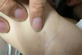 小孩子胳膊下面长三颗痘好像是头发穿过去的样子是怎么回事图片