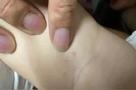 小孩子胳膊下面长三颗痘好像是头发穿过去的样子是怎么回事图片