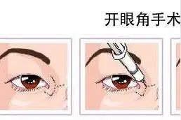 为什么做双眼皮的时候医生建议还要开个眼角？图片