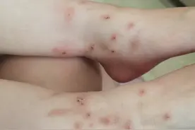 成都一居民家脏乱差还养4猫1狗全单元邻居都被跳蚤咬，民警、街道都对他无法图片