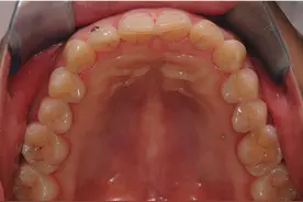 牙齿矫正扩弓会导致脸变大吗？图片