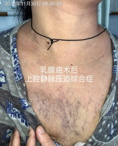 静脉输液部位选择不简单，一不小心竟“误入歧途”