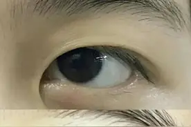 做双眼皮前医生需要设计，她们到底在设计些什么？图片