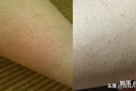 天生遗传鸡皮肤能改善？只需两步基础护理，使用产品均价不超50块图片