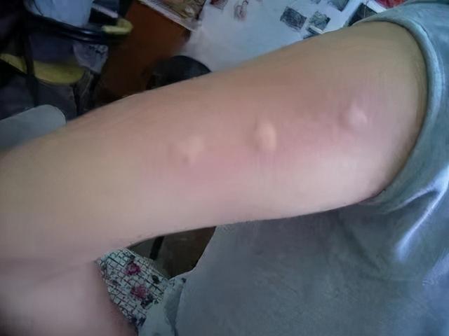 小孩被蚊子咬大包红肿怎么办 教你止痒去红肿妙招