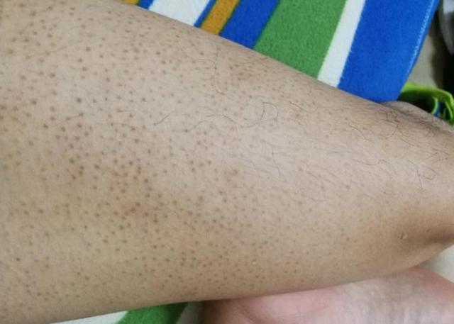 毛囊角化症腿上都抓破了