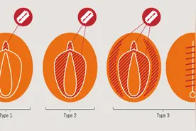 这个世界上，每年有两百万女性被割掉外生殖器图片