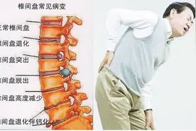 腰椎间盘突出，不手术怎么缓解？保守治疗的根本目的是什么？图片