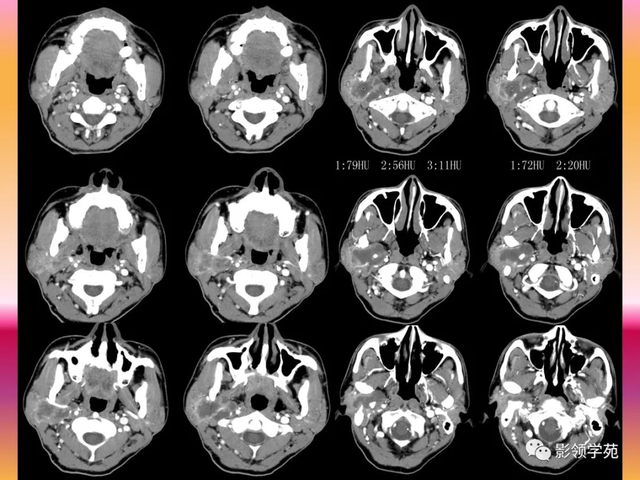 腮腺角化型鳞癌