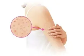 鸡皮肤是什么原因引起的？怎么治疗？能够彻底治愈吗？图片