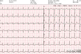 心肌缺血时心电图ST段改变图片