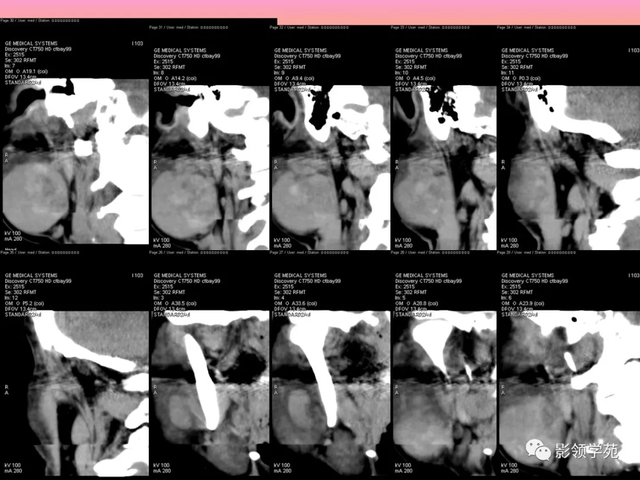 腮腺角化型鳞癌