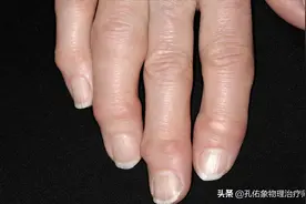 手指发胀、僵硬、握不拢，是风湿吗？不出意外，这4种可能性较大图片