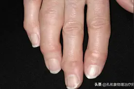 手指发胀、僵硬、握不拢，是风湿吗？不出意外，这4种可能性较大图片