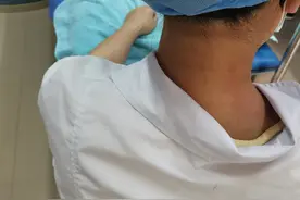 落枕用针灸两分钟见效图片