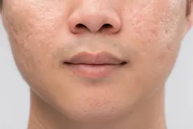 点痣留下的凹陷疤痕怎么祛除呢？图片