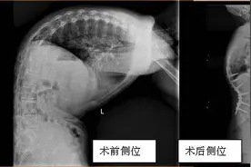 抬头有星光！32岁严重驼背男子挺直腰杆重启人生图片