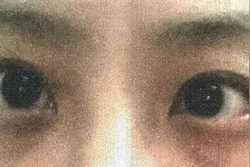 长时间看屏幕，25岁女生“眼睛斜了”！医生：手术无法恢复已经损伤的视功能图片