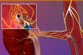 高血压微创手术治疗新方法——肾动脉去交感神经消融术图片