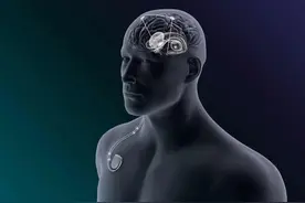 脑深部电极刺激术（DBS）对帕金森病说“不”图片