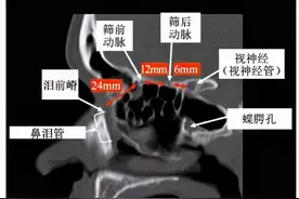 超清图解：鼻窦及颅底CT解剖图片
