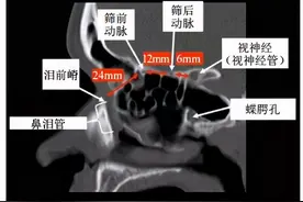 超清图解：鼻窦及颅底CT解剖图片