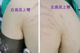 19岁小伙长“妊娠纹”，还不断长胖，罪魁祸首竟是脑中绿豆大的肿瘤图片