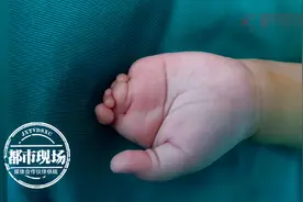 孩子出生左手只有1根手指！医生用这招，2年后手指长出来了图片