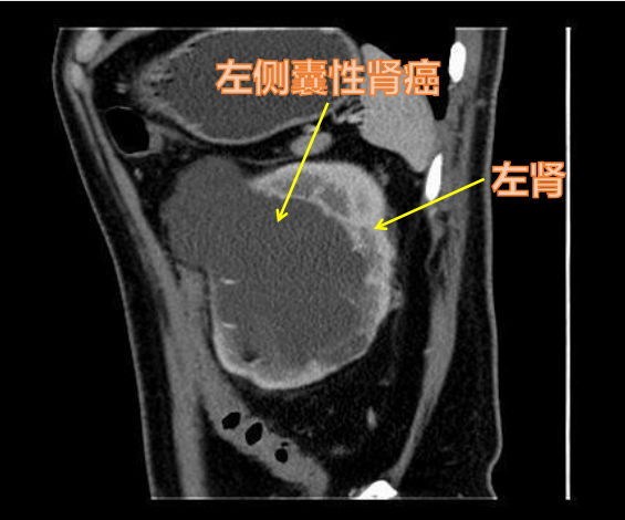 肾囊肿>5 cm不必马上手术，但囊性肾癌无论大小，都应尽快切除