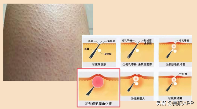 毛周角化会有黑点吗