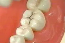 牙齿上的黑色污垢是怎么来的？要怎么清除？图片