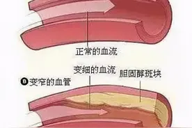 心脏支架手术后，到底能不能喝酒？看医生怎么说图片