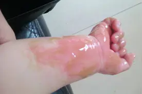 孩子被100度开水烫伤，妈妈用一小时五字诀处理，医生：做得好图片