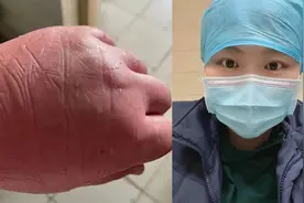 终于找到了“馒头”手的主人，问一声：你的手现在消肿了吗？图片
