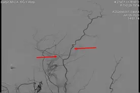 女子干农活头发卷入播种机整个头皮被掀开,哈医大一院专家妙手吻合仅有2mm血管恢复女子外貌图片