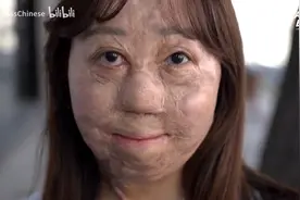 全身95%重度烧伤幸存女孩在韩国的奋斗：是爱给了我第二次生命图片