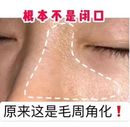 毛周角化损害