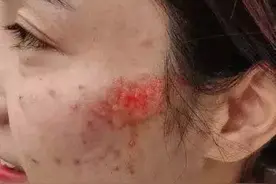 #芜检君分享#姑娘！你的脸……心疼！图片