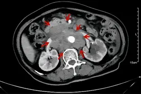 特瑞普利单抗联合化疗用于晚期食管癌取得惊人效果一例图片