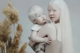 “妈妈，我怕光”，姐妹俩出生时全身雪白，网友：白色天使图片