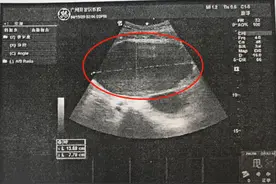 27岁女性腹内囊肿原地“爆炸”，多年痛经是它作祟！图片